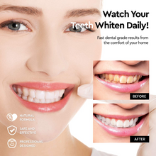 Premium Teeth Whitening Kit, LED Light, At-Home System Without Pain or Sensitivity, Effectively Removes Stains for Whiter Teeth