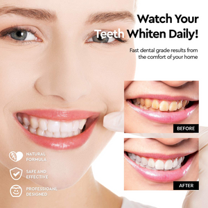 Premium Teeth Whitening Kit, LED Light, At-Home System Without Pain or Sensitivity, Effectively Removes Stains for Whiter Teeth