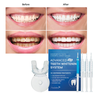 Premium Teeth Whitening Kit, LED Light, At-Home System Without Pain or Sensitivity, Effectively Removes Stains for Whiter Teeth