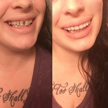 Great Smile Veneer (Upper & Lower)