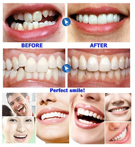 INSTANT SMILE VENEER - Upper & Lower Included