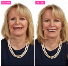 INSTANT SMILE VENEER - Upper & Lower Included