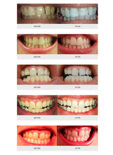 Teeth Whitening Kit, LED Light, 35% Carbamide Peroxide, (2) 5ml Gel Syringes, Tray and Case